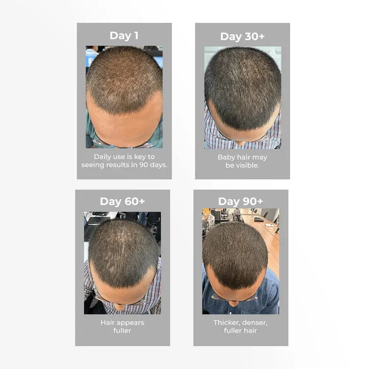 3% Redensyl   4% Anagain Hair Growth Serum for Men
