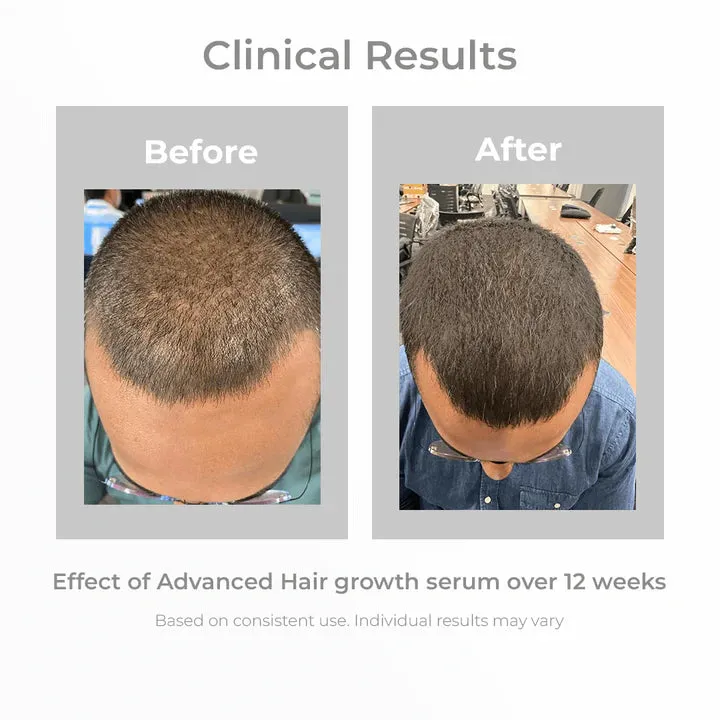 3% Redensyl   4% Anagain Hair Growth Serum for Men